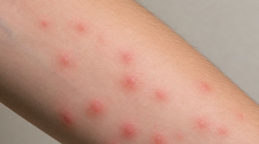 Arm with midge bites