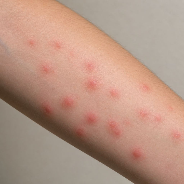 Midge bits on person