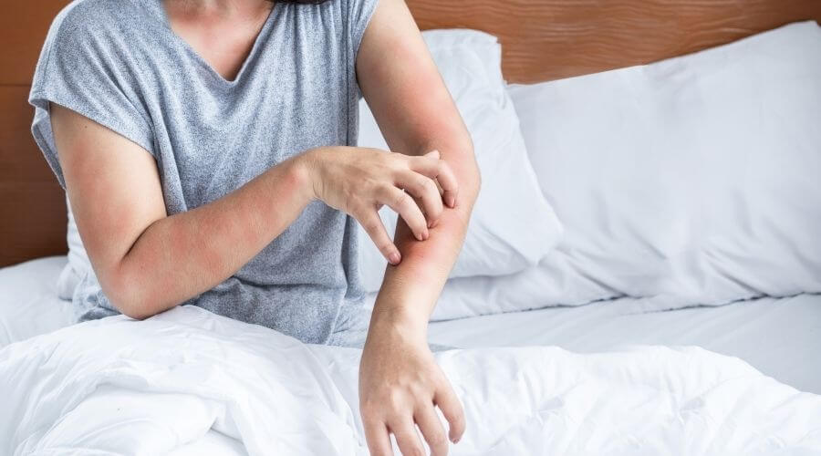 Woman scratching bed bug bites